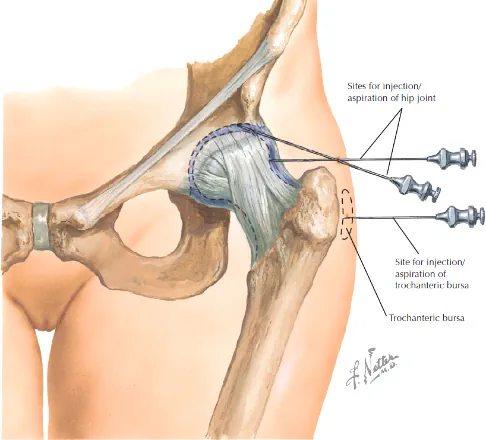 Ilustração esquemático de tratamento por infiltração no quadril