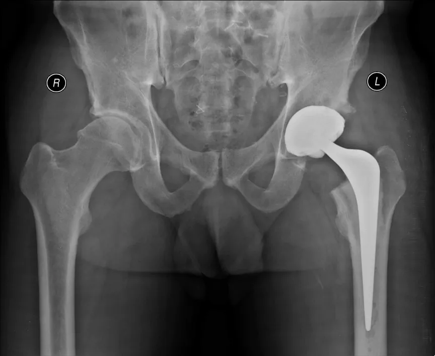 Chapa de raio-X de quadril com prótese